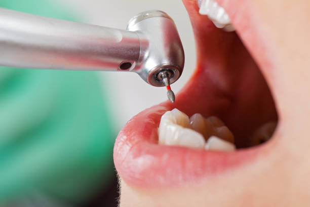 Best Emergency Dental Care for Abscessed Tooth in Fairfax, OH
